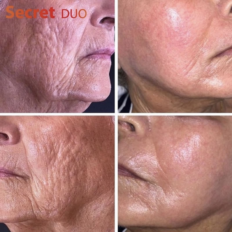 SF duo microneedling